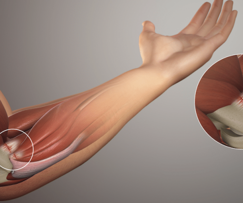 Golfer’s Elbow: Causes & Cures